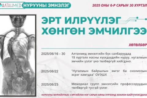 Өсвөр насны хүүхдэд илэрдэг сколиозын шинж тэмдгийг анзаарахгүй байснаар мурийлт нь ихэсдэг