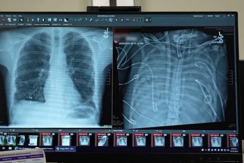 Хоёр уушгиа авахуулсан өвчтөн хиймэл уушгины аппаратаар хоёр хоног амьдарчээ