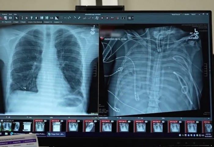 Хоёр уушгиа авахуулсан өвчтөн хиймэл уушгины аппаратаар хоёр хоног амьдарчээ